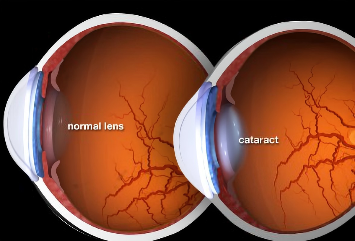 Cataracts Disease : मोतियाबिंद के लिए जागरूकता का आभाव