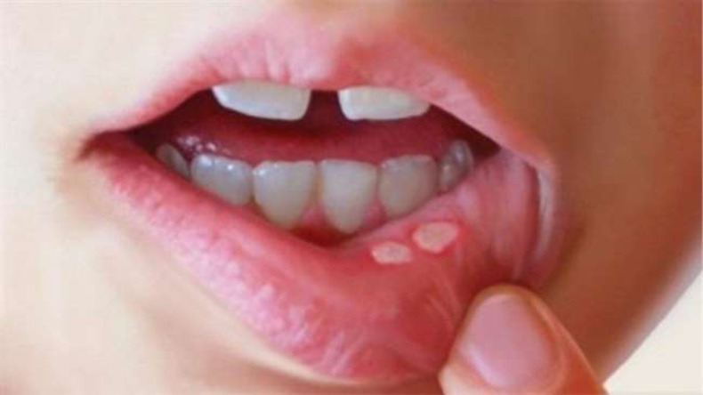 Mouth ulcers: अगर आपके मुंह में पड़े हैं छालें तो अपनाएं ये तरीका