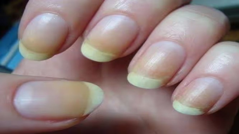 Nails and Health: क्या आपके नाखून भी पड़ रहे हैं पीले? तो ये हो सकते हैं बैड कोलेस्ट्राल बढ़ने के सकेंत