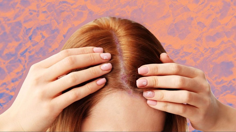 Scalp Psoriasis: सिर पर ड्राईनेस और खुजली से ऐसे पाएं छुटकारा, इन उपायों को अपनाएं