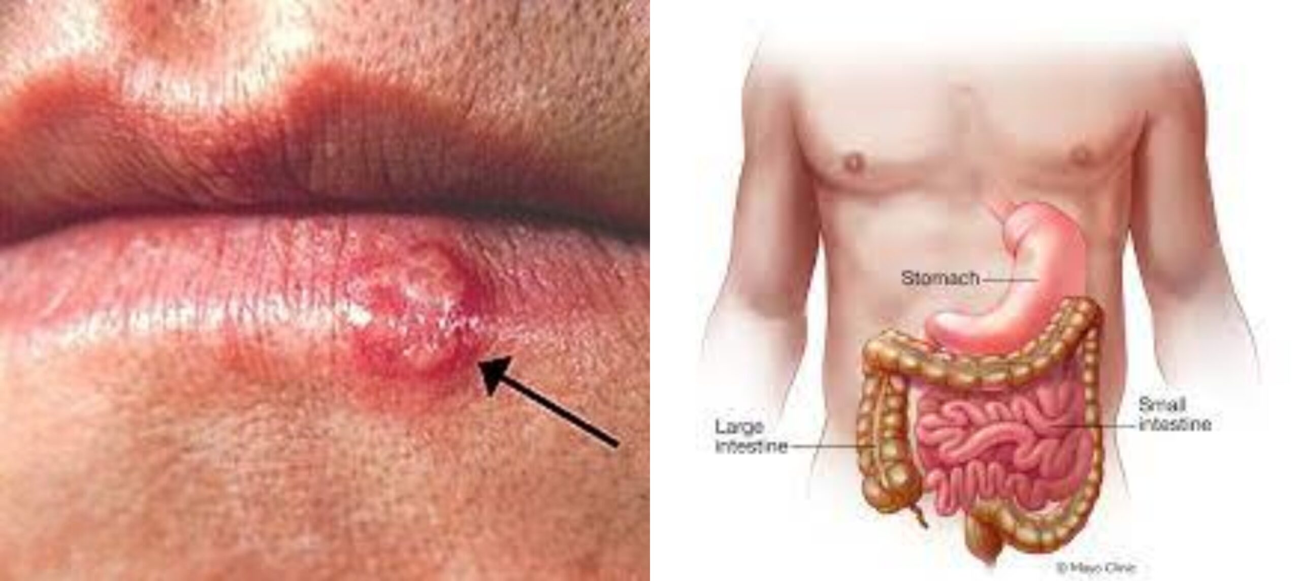 Herpes And Gastroenteritis: आखिर क्या है स्टमक फ्लू और हर्पीस? जानिए इनके बीच का संबंध