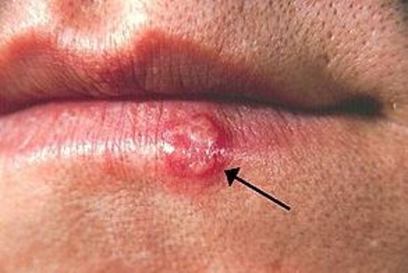 Herpes: एक सामान्य वायरल संक्रमण जो टच से फैंले, हर्पेस के प्रकार और लक्षण के बारें में इसे पढ़ पाए जानकारी