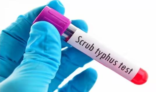 Scrub Typhus:  हिमाचल में स्क्रब टाइफस से महिला ने तोड़ा दम, दूसरी मौत को किया रिकॉर्ड, IGMC शिमला में पाए 102 पॉजिटिव