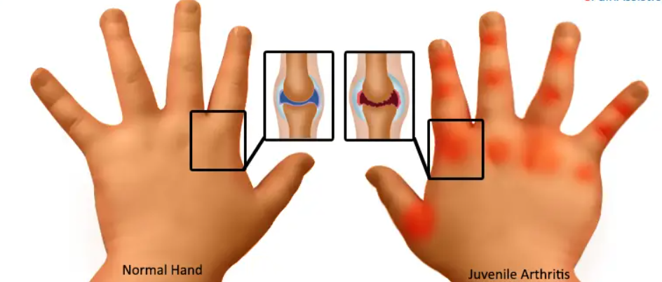 Juvenile Arthritis: जुवेनाइल आर्थराइटिस बनाये बच्चो को अपंग, जानिए इसके प्रकार, कारण और इलाज के बारे में