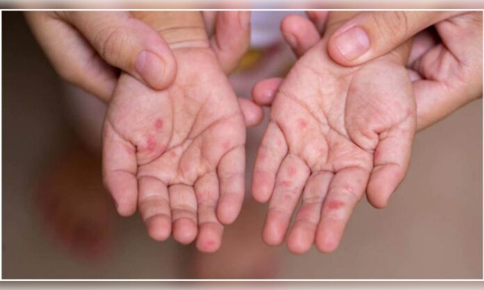 Measles (Khasra) symptoms