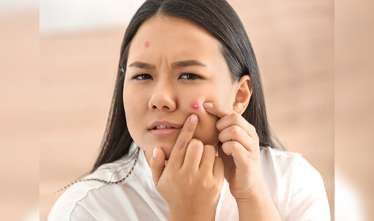 Skin Care: गर्मियों में पिंपल्स कर रहे परेशान? अपनाएं ये टिप्स