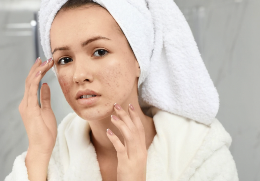 Acne Causes: चेहरे पर होने वाले एक्ने देते है गंभीर बीमारी का संकेत! जानिए क्या है वजह