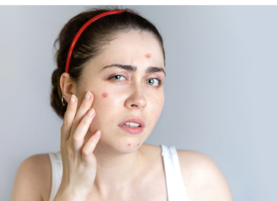 Monsoon Acne:  मानसून में मुंहासों से परेशान? इन 5 आदतों में बदलाव लाएं तुरंत फर्क