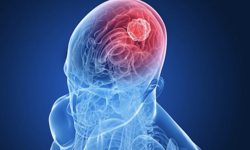 Brain Tumor Signs: समय पर पहचान और इलाज से बच सकती है जान, जानें ब्रेन ट्यूमर के लक्षण